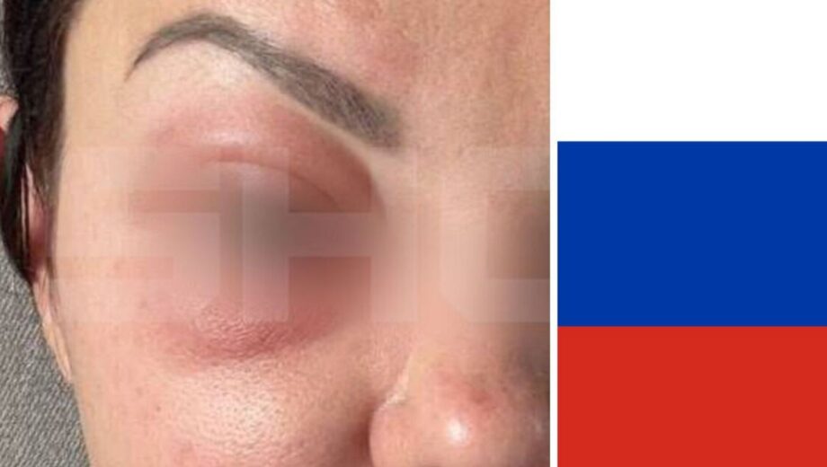 В россии десятки женщин стали жертвами косметологии: к введенному им препарату нет антидотов