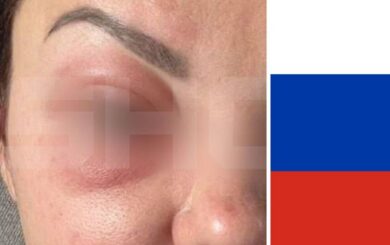 У росії десятки жінок стали жертвами косметології: до введеного їм препарату немає антидотів