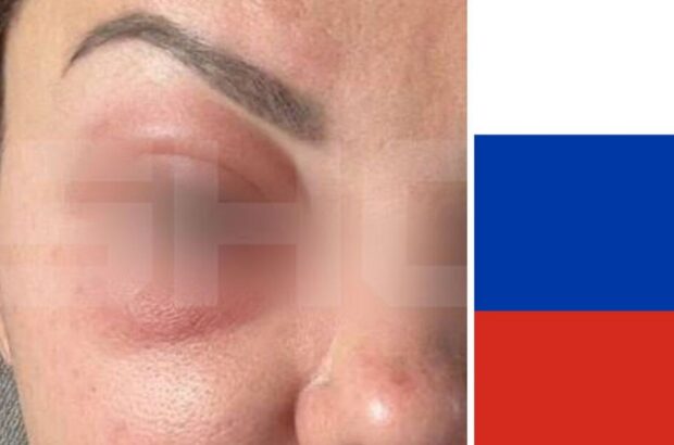 У росії десятки жінок стали жертвами косметології: до введеного їм препарату немає антидотів