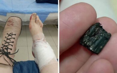 Уламки влучили в ногу: журналістка видання ”Накипіло” потрапила під обстріл у Харкові