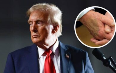 Набряки та синці: Трамп пройшов обстеження, діагностовано венозну недостатність