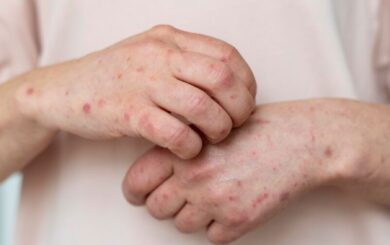 В Украине зафиксировали вспышку ветрянки: медики советуют избегать скоплений