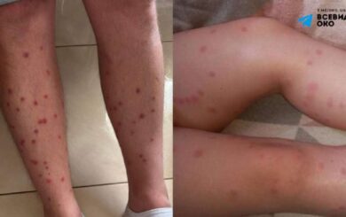 Відпочивальники скаржаться на свербіж і висип після купання у Світязі